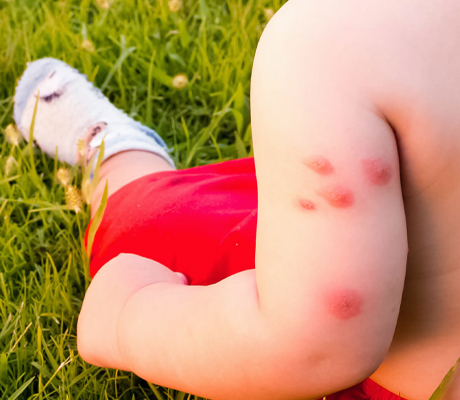 ¿Tu hijo sufrió una picadura? Caladryl es el auxiliar ideal en su cuidado.