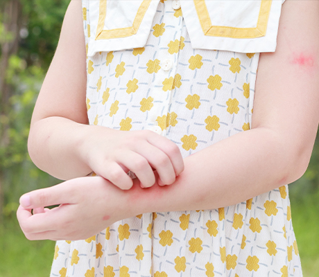 Cómo evitar que los niños se rasquen durante la varicela