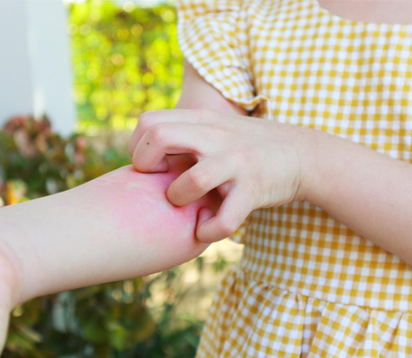 Dato curioso Caladryl: ¿Por qué dan comezón las picaduras de insectos?