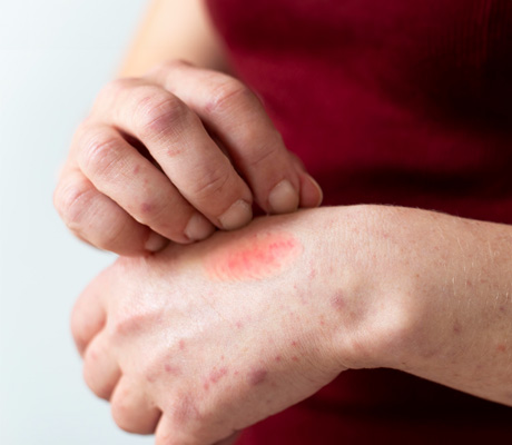 Piquete de Garrapata