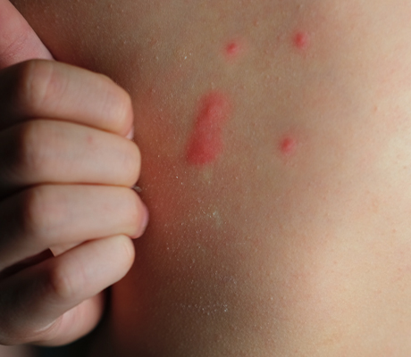 Ronchas en la piel de tus hijos