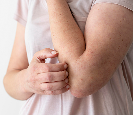 Cómo aliviar el ardor de ampollas y raspaduras