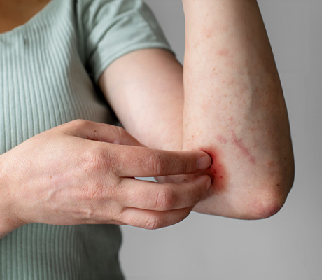 Urticaria por frío. Protege tu piel para no sufrir los efectos