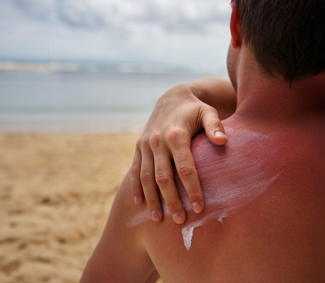 Las quemaduras solares, ¿sólo se dan en la playa?