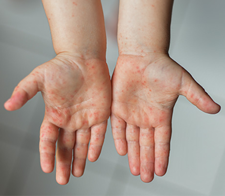 Conoce los tipos de sarpullido en la piel y qué los provoca