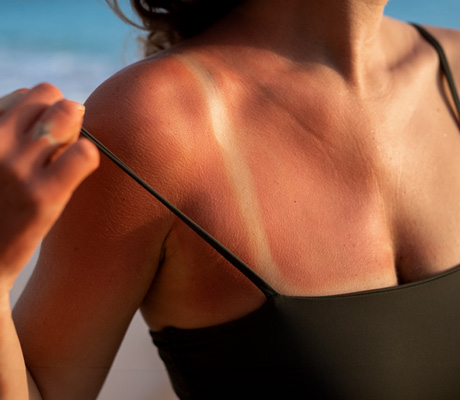 Quemaduras, cómo distinguir si es de primer, o segundo grado