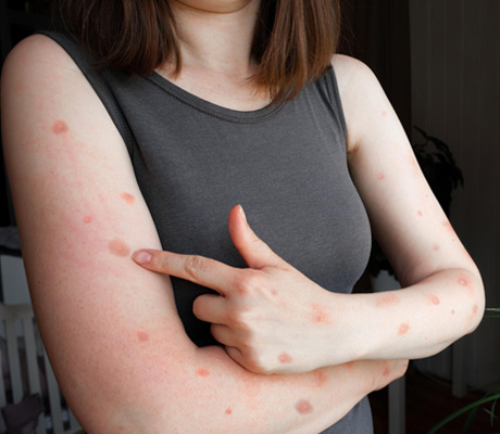 Ronchas en la piel, Causas y Soluciones