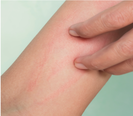 La simple comezón puede producir afectaciones graves en la piel