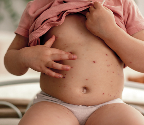 Cuáles son los síntomas de la varicela