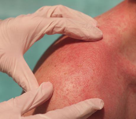 Qué es la dermatitis