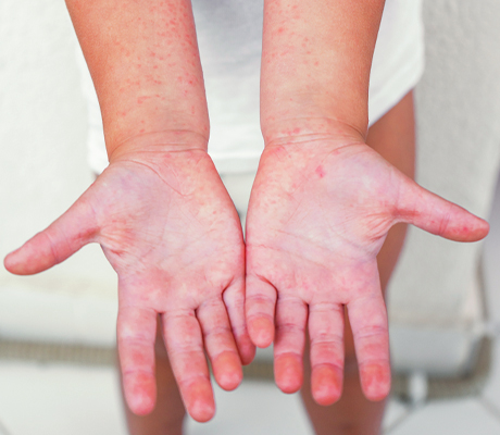 Qué es el sarpullido