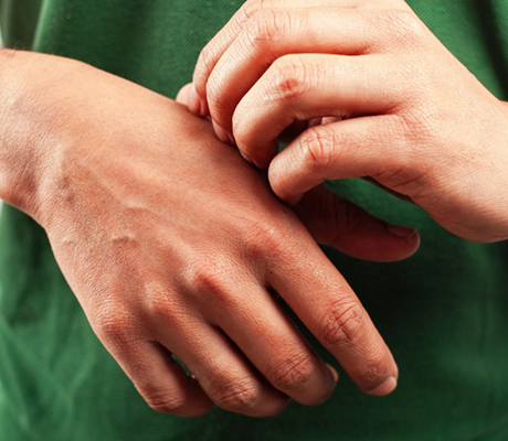 Alivia la comezón por alergias en la piel