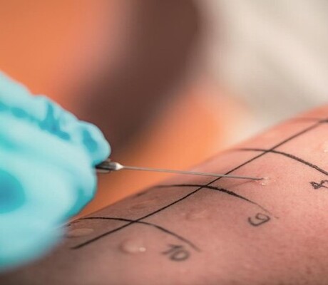 Cómo se produce una alergia