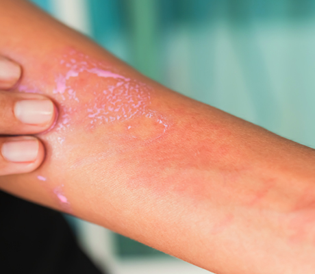 Caladryl - Sarpullido por calor Que debo hacer