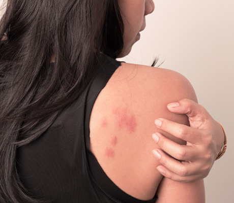 Cómo saber qué insecto me picó