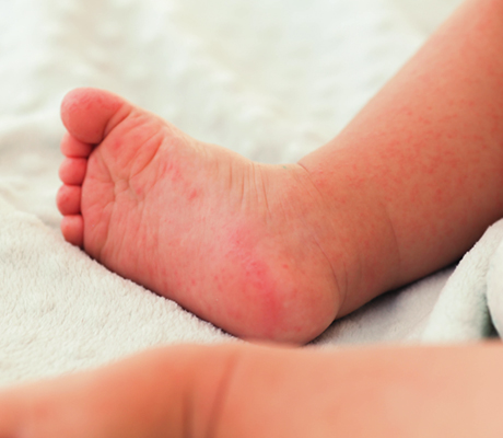 Caladryl - Sarpullido en bebés, causas y tratamiento